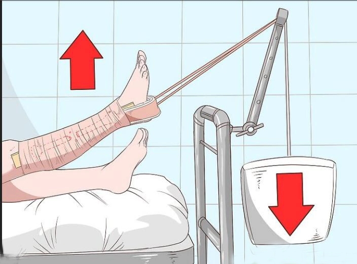 كيفية استخدام Skin Traction Kit