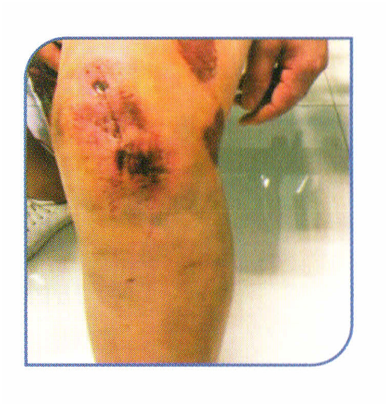 ضمادة تبريد بارد بارد